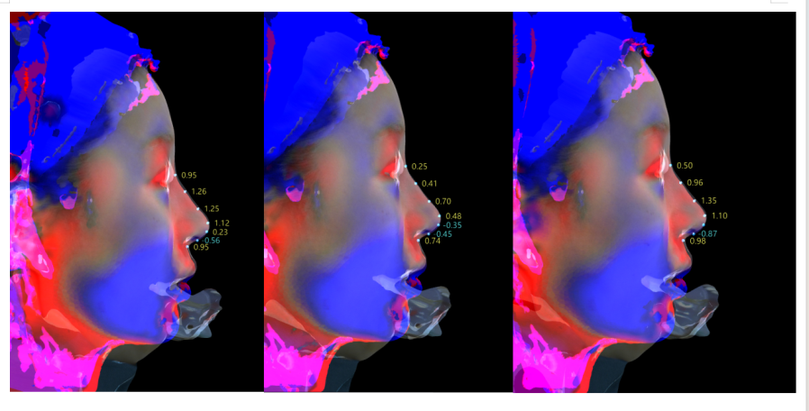 奇异果app官网下载：3D数字化时间行使让鼻整形迈进定制化时间(图3)