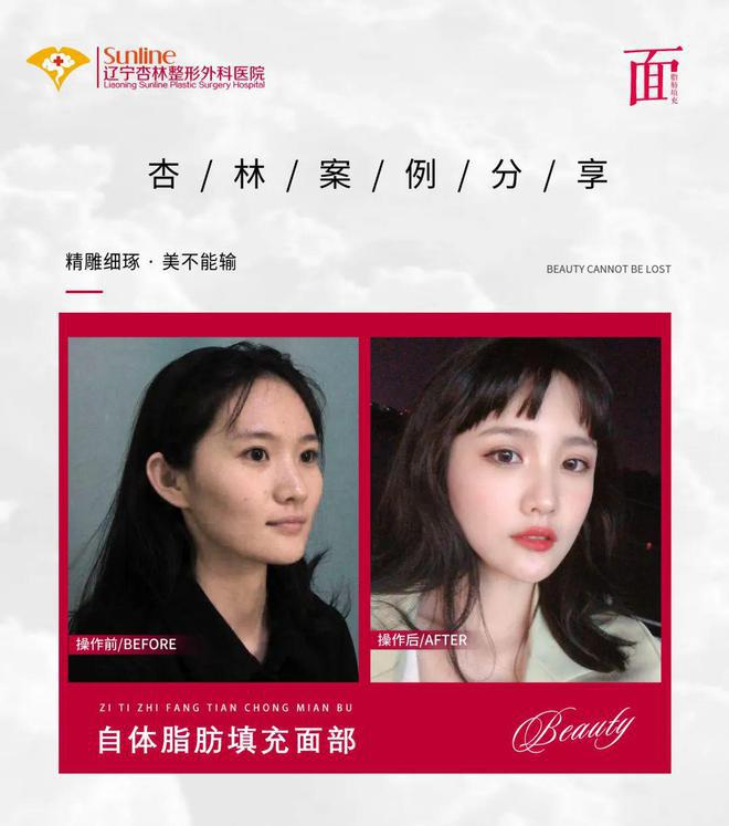 奇异果app：辽宁杏林整形外科：吸脂后的脂肪白白扔掉？不懂诈骗就亏大了(图5)