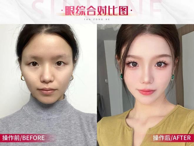 奇异果app：辽宁杏林整形：四种“点名率高”的双眼皮气派必看(图2)